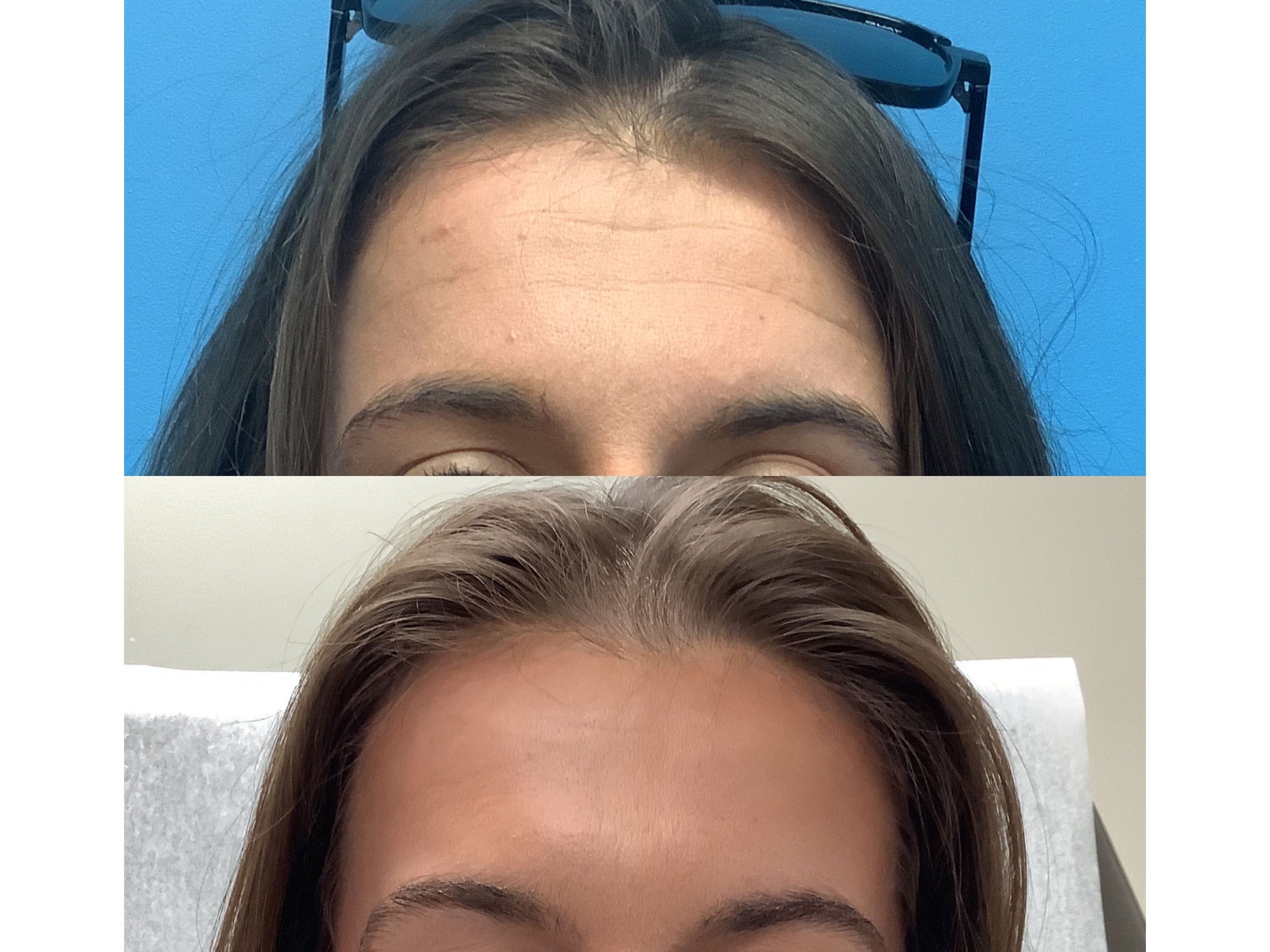 Before and after forehead smoothing with neuromodulator treatment
