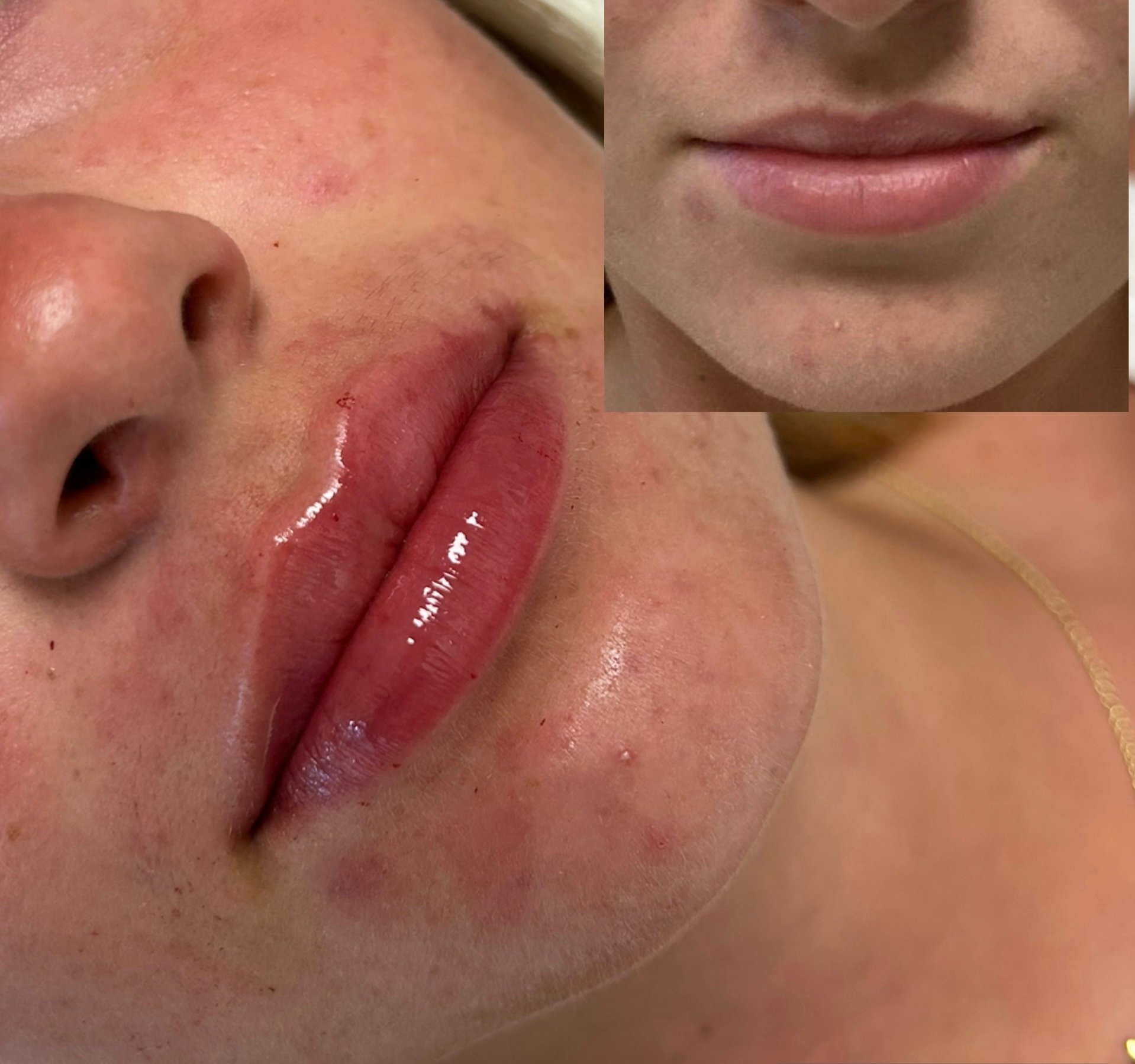 Before and after lip filler with fuller, defined lips