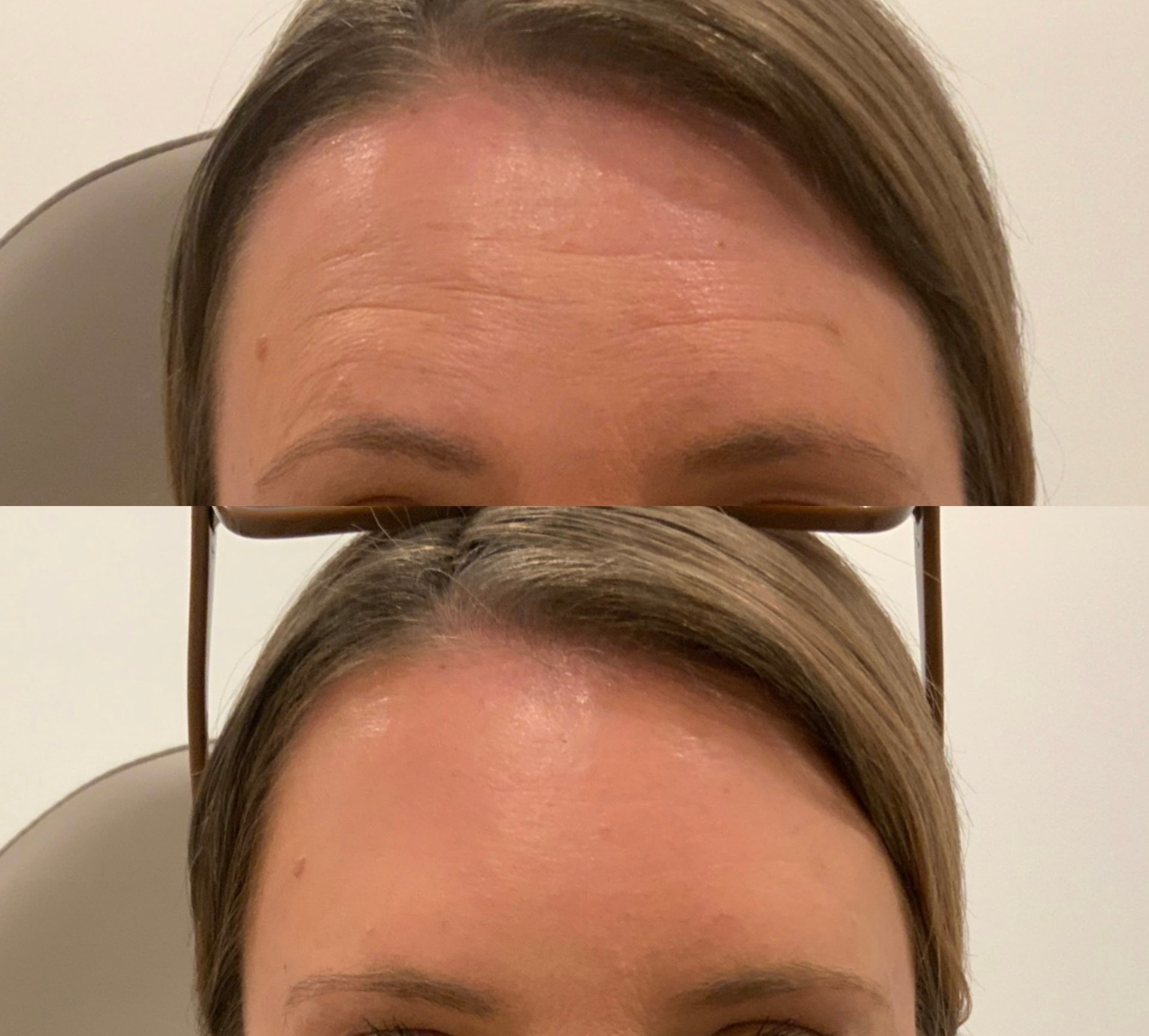 Before and after forehead lines softened with neuromodulator treatment