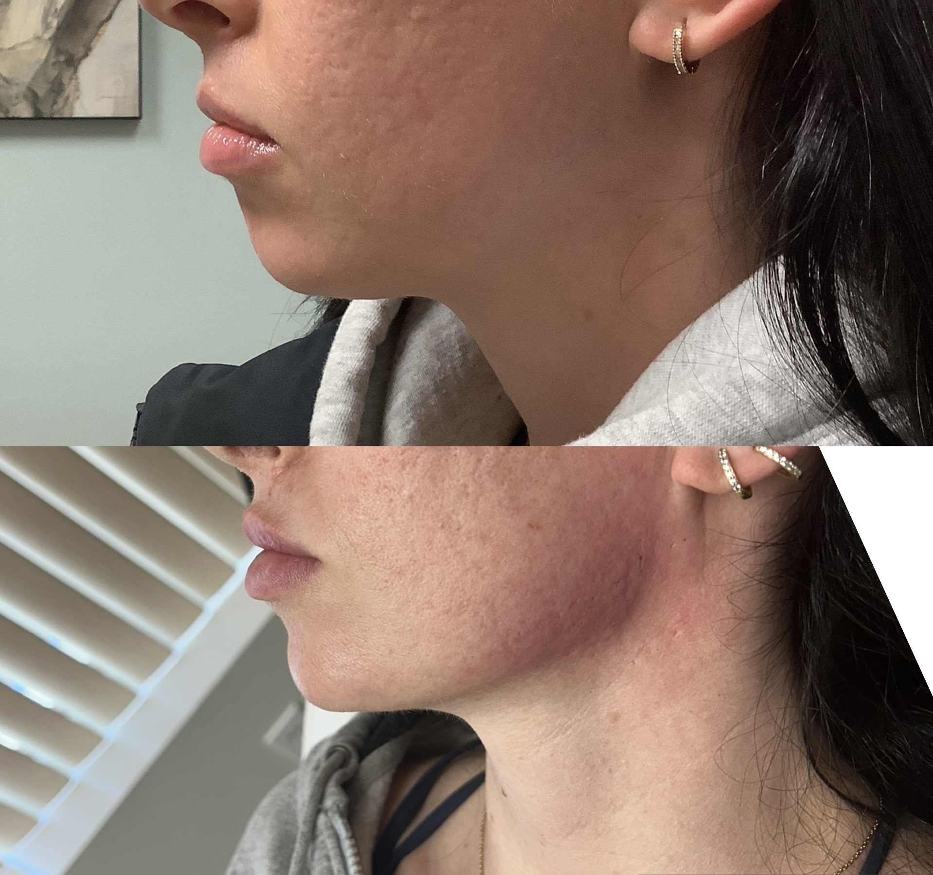 Before and after jawline and chin filler contouring
