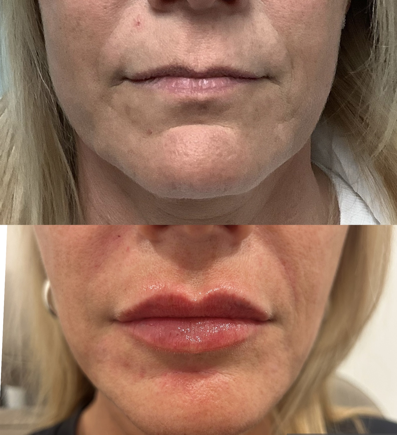 Before and after lip filler enhancement