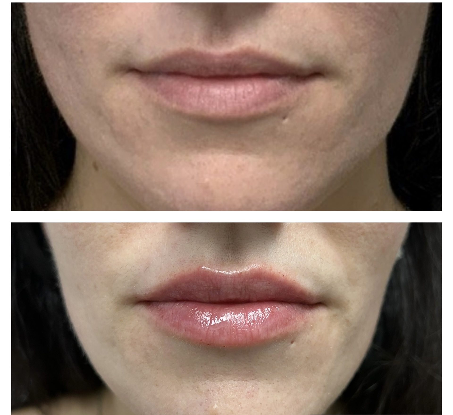 Before and after lip sprinkle using one-third of a syringe of filler