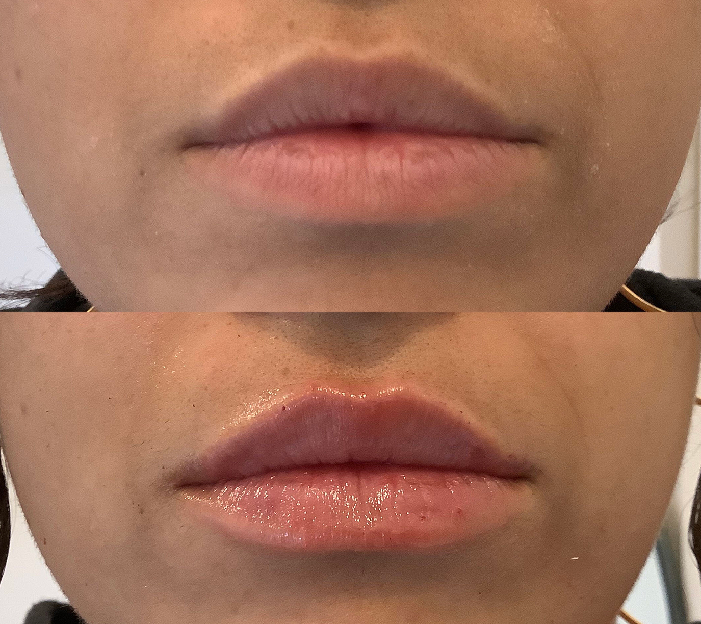 Before and after subtle lip sprinkle with one-third of a syringe of filler